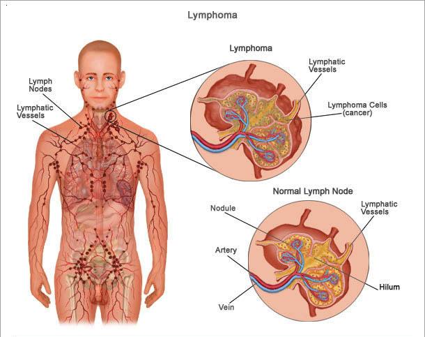 lymphoma3