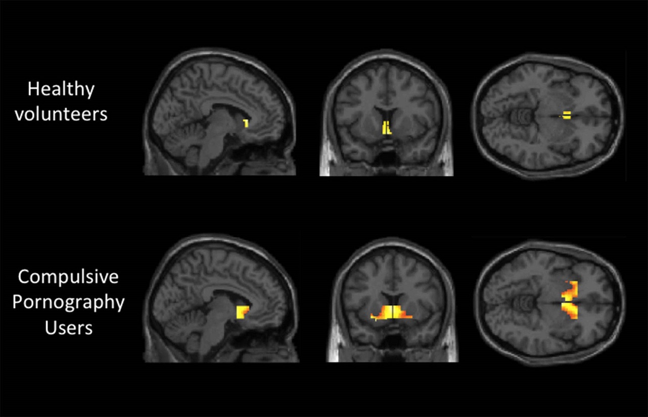 Your Brain on Porn: How Porn Consumption Changes Your Brain Structure ...